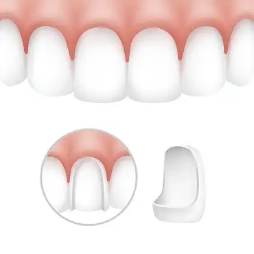 Dental aesthetics - indirect veneering
