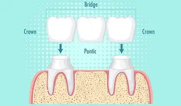 Punti dentare