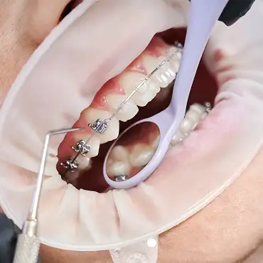 Aparat dentar Damon