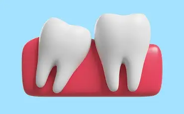 Cum arata un molar de minte semi-inclus