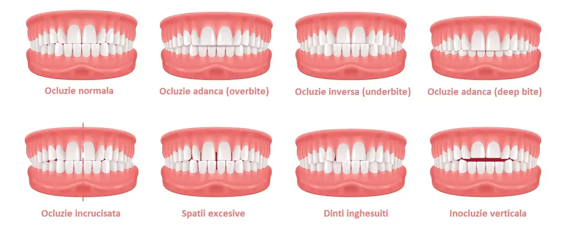 Tipuri de ocluzie dentara