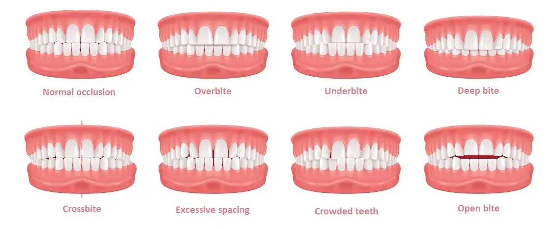 Types of dental occlusion