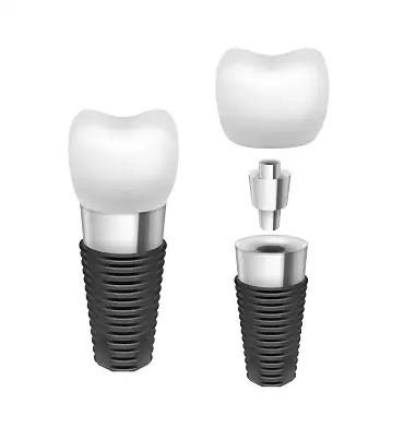 Desen implant
