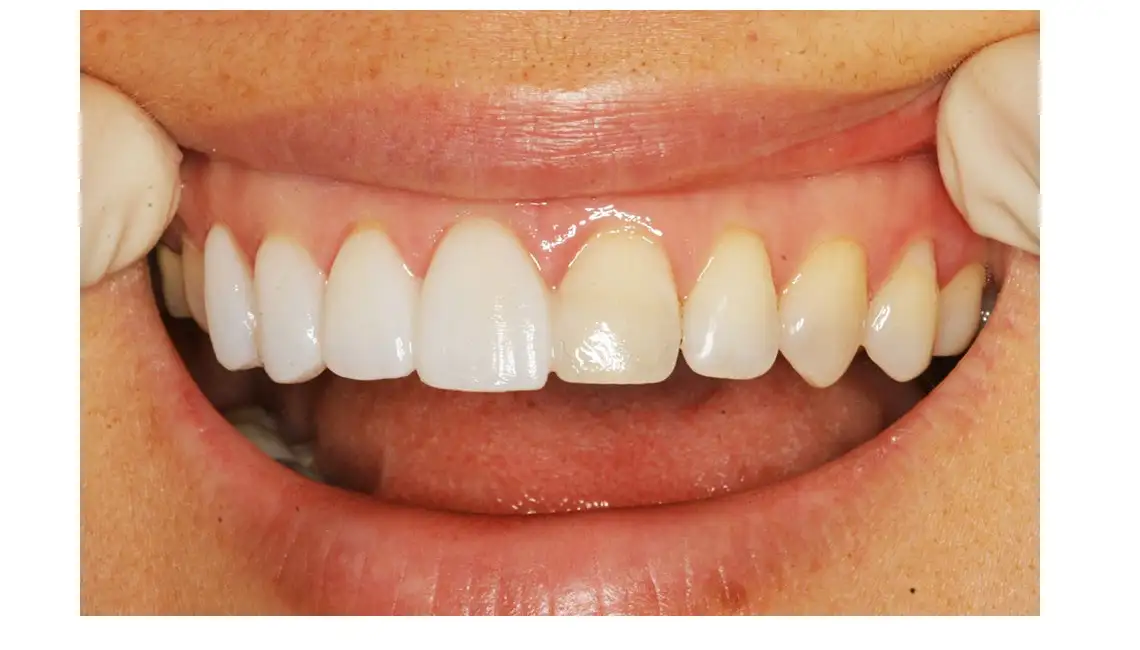 Fatete dentare Lumineers