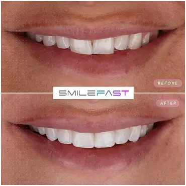 SmileFast poza de aproape
