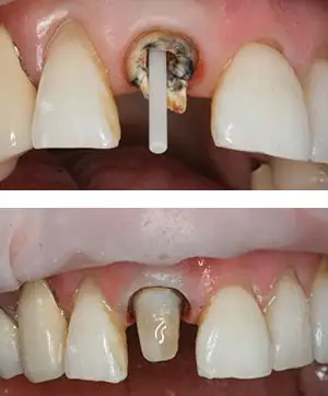 Pivot dentar