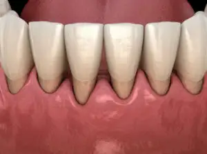 Retractie gingivala
