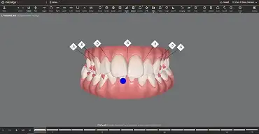 Invisalign ClinCheck
