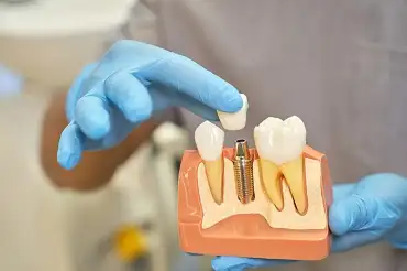 Exemplu de implant pe plastic